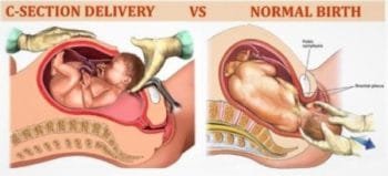 C-section (Cesarean Delivery)  How C-Section is Performed? 