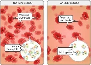 low hematocrit and hemoglobin in pregnancy