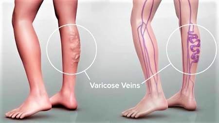 Varicose Veins During Pregnancy: Causes and Treatment