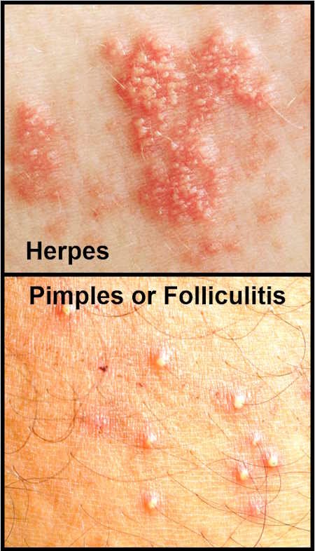 Herpes Vs Pimples How To Spot The Difference Doctor Zara