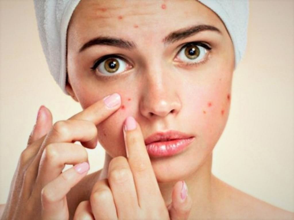 Acne Causes and Treatment - Doctor Zara