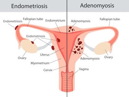 adenomyosis vs endometriosis