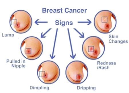 breast cancer symptoms pictures