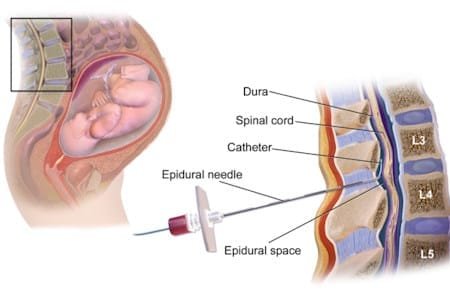 painless delivery epidural injection