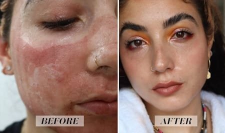 co2 laser resurfacing before and after recovery photos