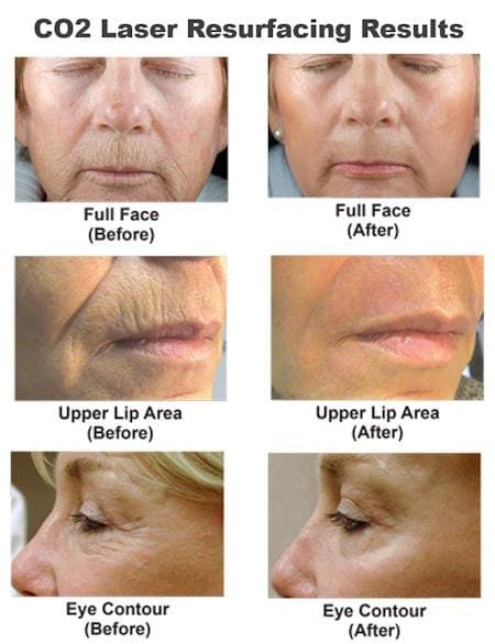 before and after co2 laser resurfacing recovery photos
