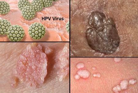 human papillomavirus HPV pictures HPV Warts women