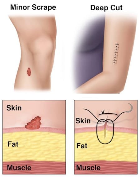 treat minor injury cut scrape