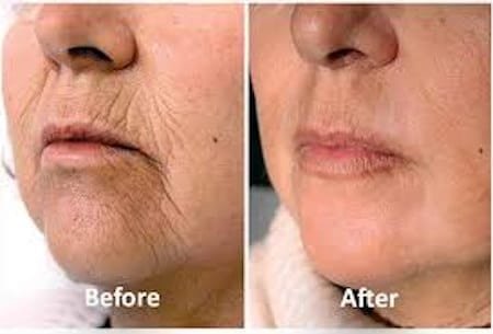 skin tightening before and after pictures skin tightening cream renuvion skin tightening fibroblast skin tightening laser skin tightening