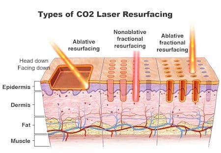 types of co2 laser resurfacing treatments