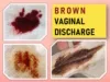 Brown vaginal discharge causes treatment