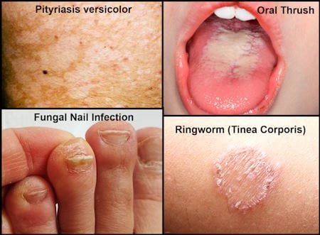 fungal infection symptoms pictures