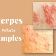 cold sore, genital herpes vs pimple, difference