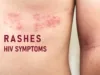 how to identify hiv rash pictures