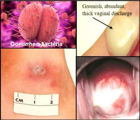 Gonorrhea Symptoms in Women thick white yellow green discharge