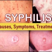 syphilis symptoms early stage, syphilis rash face legs thigh nasal pictures, syphilis treatment