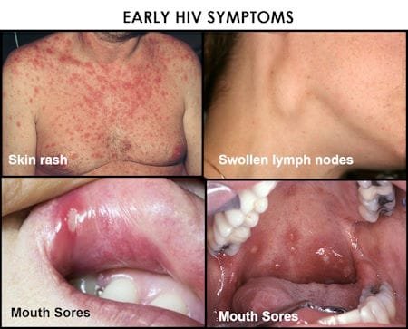 early stage how to identify hiv rash pictures, hiv mouth ulcer, hiv symptoms women