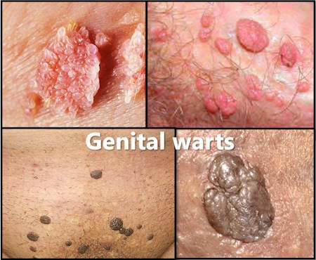 genital warts vs skin tags: pictures hpv men women