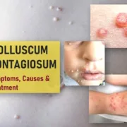 molluscum contagiosum std pictures symptoms treatment