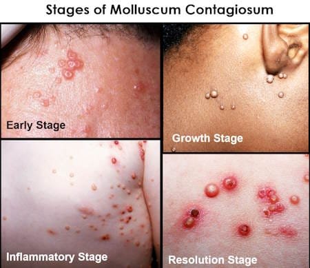stages of molluscum contagiosum pictures initial end healing final