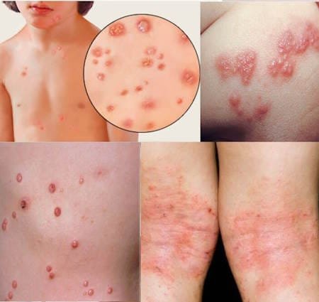 stages of molluscum contagiosum pictures initial end healing final