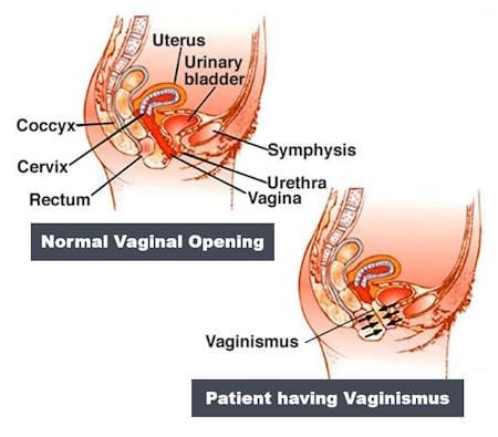 how to treat vaginismus at home vaginismus picture
