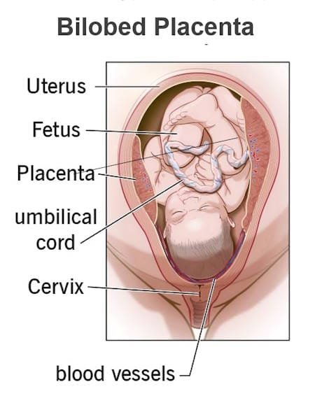 bilobed placenta, is bilobed placenta dangerous, bilobed placenta risks