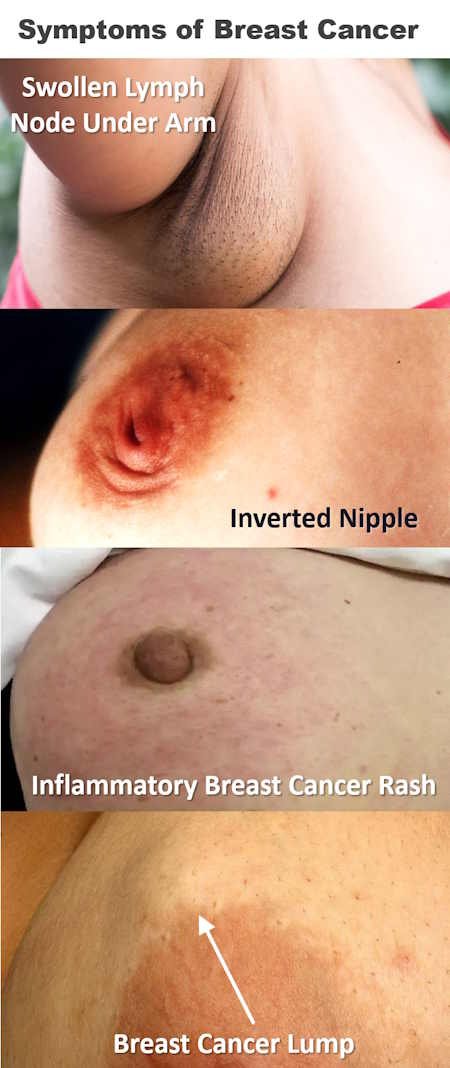 breast cancer symptoms signs, breast cancer rash lump pictures, inflammatory breast cancer in early stages real pictures