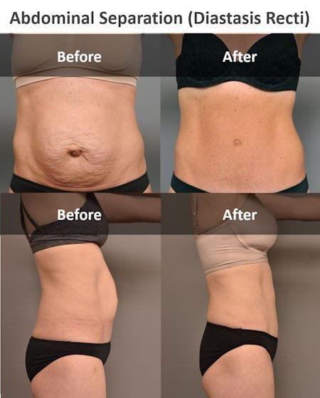 diastasis recti before and after, how to fix diastasis recti years later, pictures of severe diastasis recti