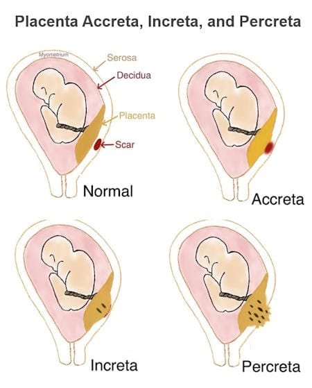 placenta accreta, increta, and percreta, types of placenta abnormalities