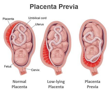 placenta previa, abnormal placenta images, bilobed placenta