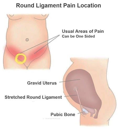 Round Ligament Pain Location, Round Ligament Pain not pregnant
