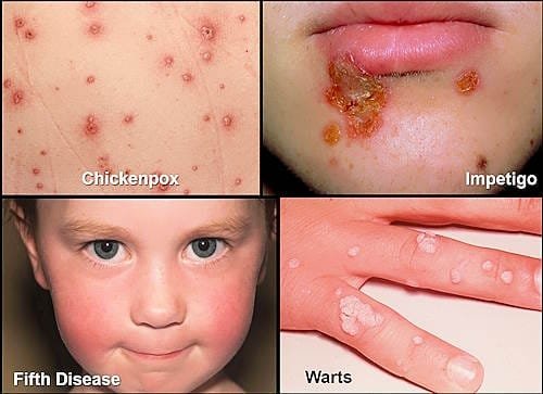 Skin rash pictures, Fifth Disease, Chickenpox, Impetigo, Warts