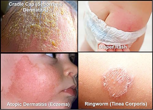 Skin Rash pictures, Diaper Rash, Cradle Cap (Seborrheic Dermatitis),Eczema, Ringworm
