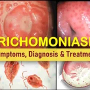 Trichomoniasis Trich Symptoms men women, Causes trichomoniasis Treatment, Medication, trichomoniasis discharge, cervix pictures