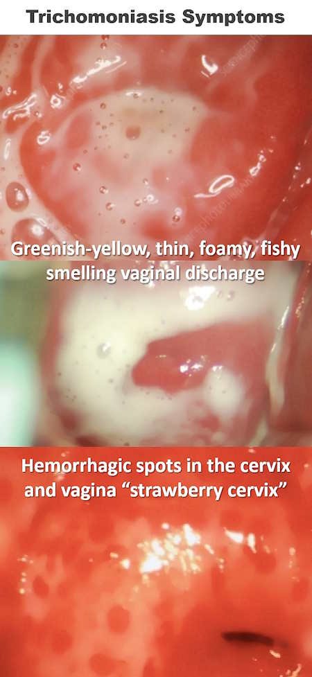 Trichomoniasis Trich Symptoms discharge, cervix pictures trichomoniasis symptoms in women