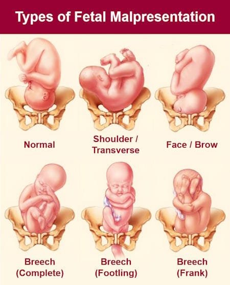 what is fetal malpresentation , types of fetal malpresentation , breech , face, transverse, oblique, cord 