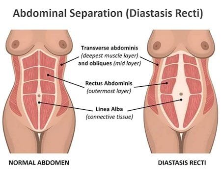 diastasis recti before and after, how to fix diastasis recti years later, pictures of severe diastasis recti