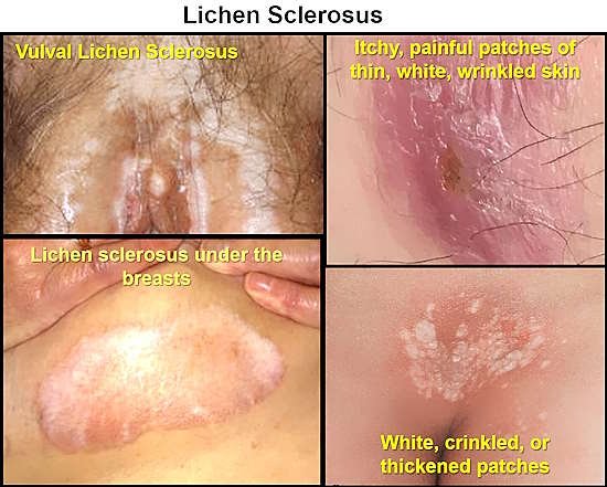 lichen sclerosus pictures, self care, home remedies, diet, Itchy, painful patches of thin, white, wrinkled skin, itchy white spots on vagina, 