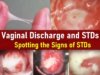 Vaginal Discharge and STDs, STI Discharge Color, what STD Discharge Look Like